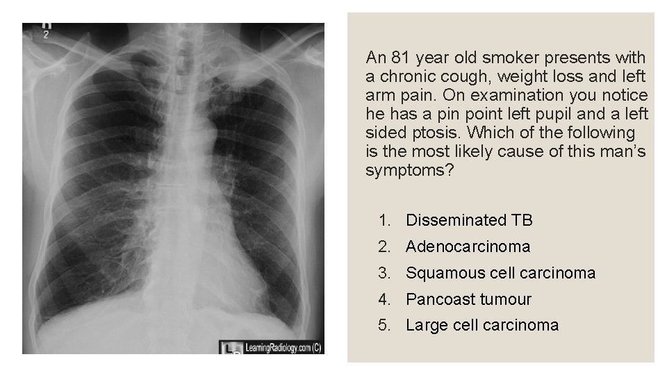 An 81 year old smoker presents with a chronic cough, weight loss and left