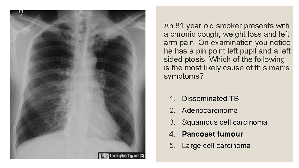 An 81 year old smoker presents with a chronic cough, weight loss and left