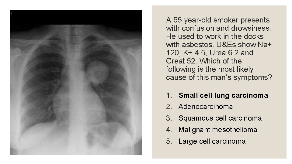 A 65 year-old smoker presents with confusion and drowsiness. He used to work in
