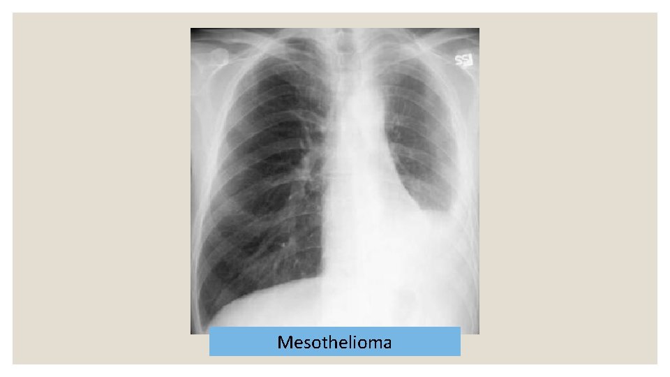 Mesothelioma 