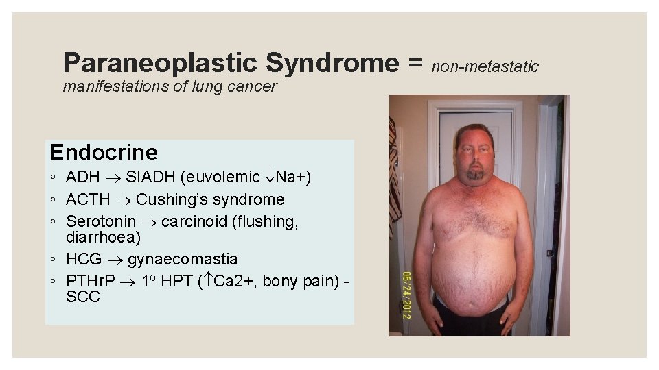 Paraneoplastic Syndrome = non-metastatic manifestations of lung cancer Endocrine ◦ ADH SIADH (euvolemic Na+)