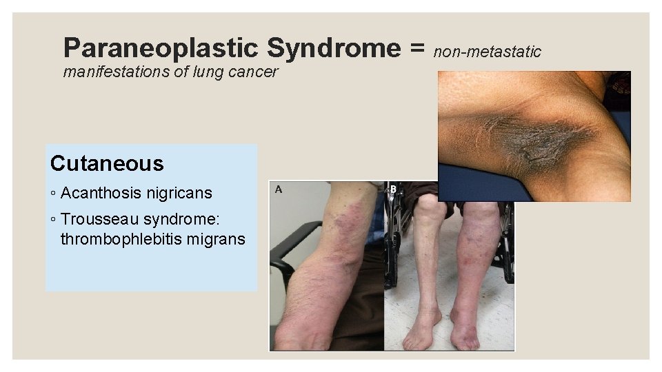 Paraneoplastic Syndrome = non-metastatic manifestations of lung cancer Cutaneous ◦ Acanthosis nigricans ◦ Trousseau