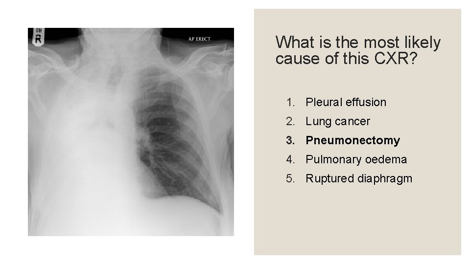 What is the most likely cause of this CXR? 1. Pleural effusion 2. Lung