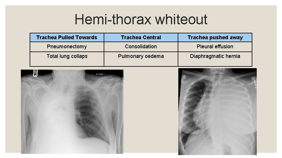 Hemi-thorax whiteout Trachea Pulled Towards Trachea Central Trachea pushed away Pneumonectomy Consolidation Pleural effusion