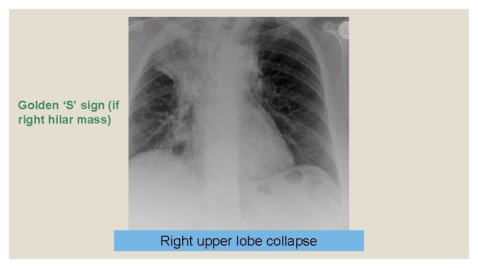 Golden ‘S’ sign (if right hilar mass) Right upper lobe collapse 