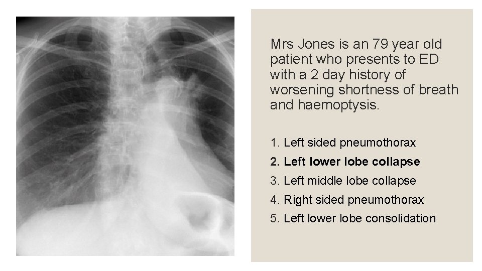 Mrs Jones is an 79 year old patient who presents to ED with a