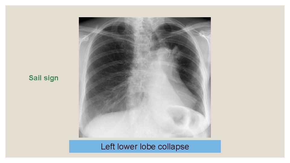 Sail sign Left lower lobe collapse 