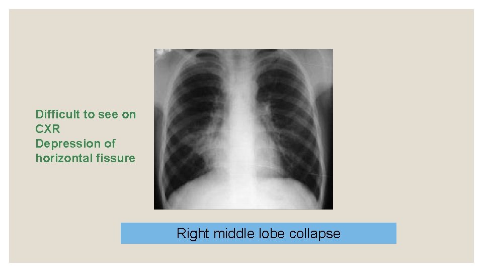 Difficult to see on CXR Depression of horizontal fissure Right middle lobe collapse 