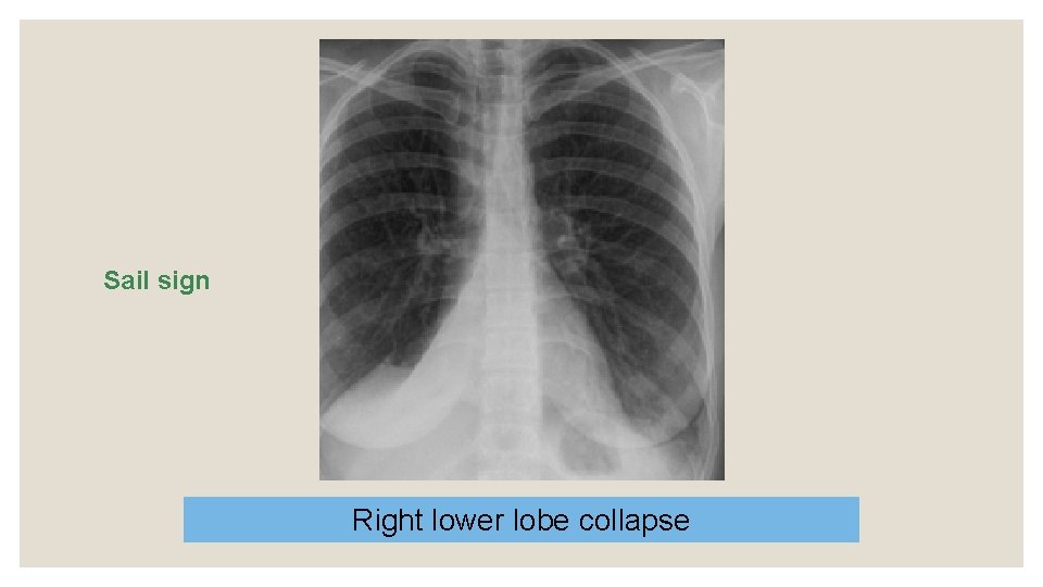 Sail sign Right lower lobe collapse 