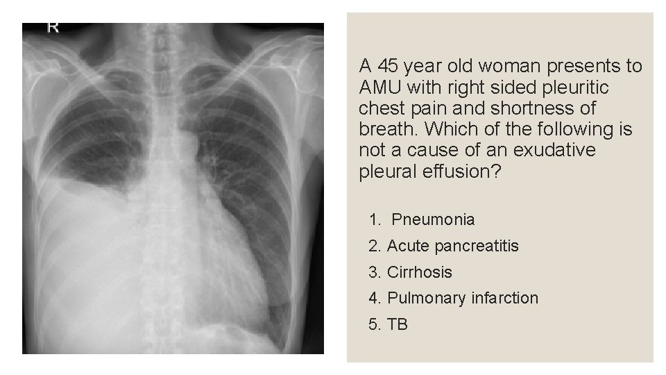 A 45 year old woman presents to AMU with right sided pleuritic chest pain