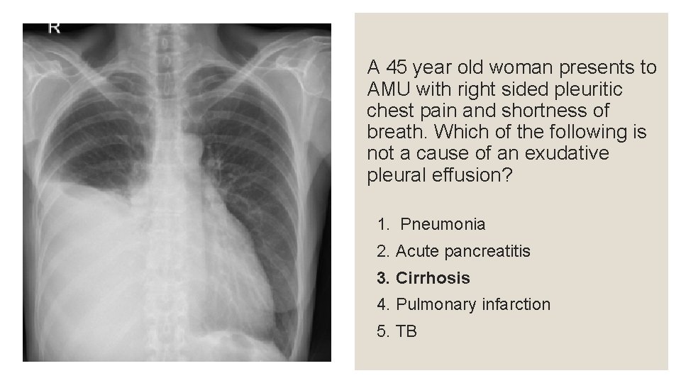 A 45 year old woman presents to AMU with right sided pleuritic chest pain