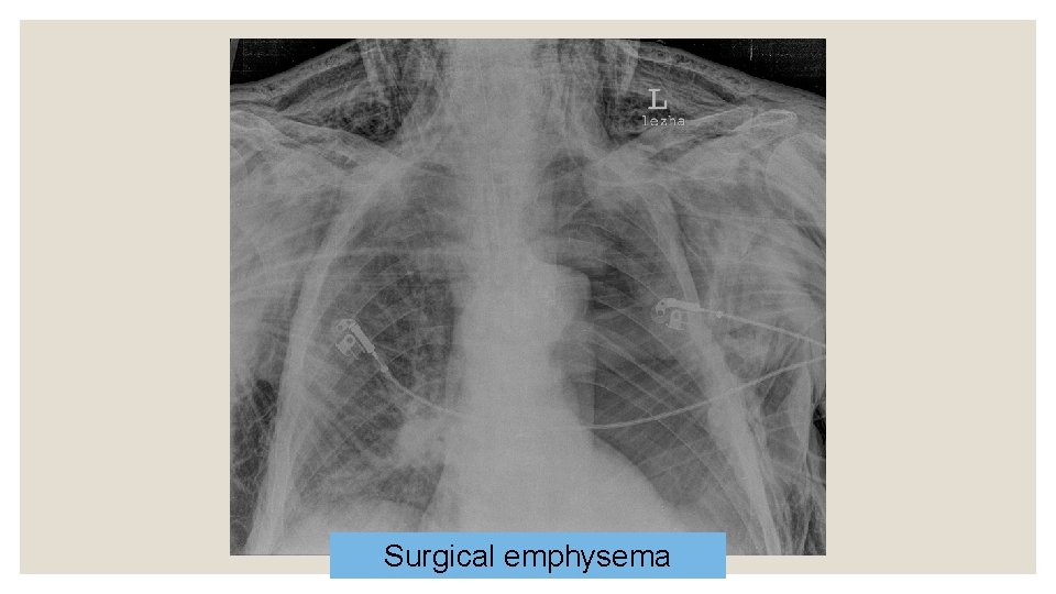 Surgical emphysema 
