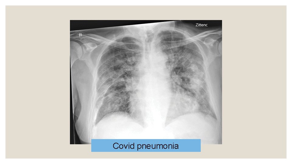 Covid pneumonia 