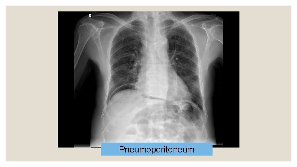 Pneumoperitoneum 