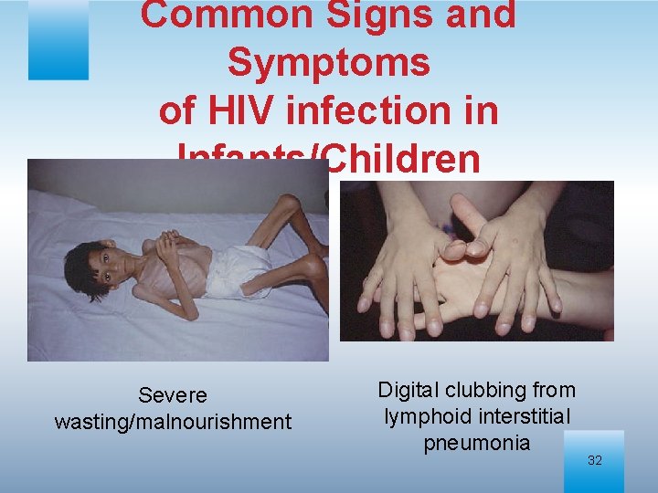 Common Signs and Symptoms of HIV infection in Infants/Children Severe wasting/malnourishment Digital clubbing from
