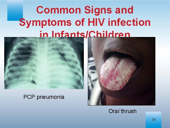 Common Signs and Symptoms of HIV infection in Infants/Children PCP pneumonia Oral thrush 34