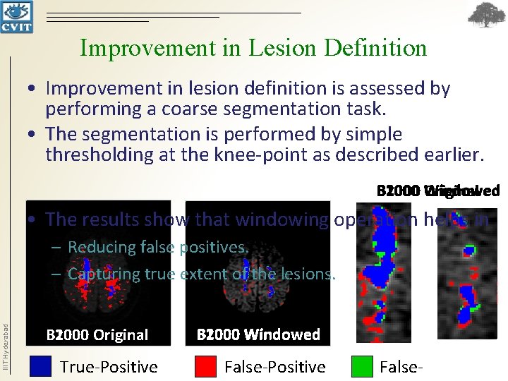 Improvement in Lesion Definition • Improvement in lesion definition is assessed by performing a Improvement in Lesion Definition • Improvement in lesion definition is assessed by performing a