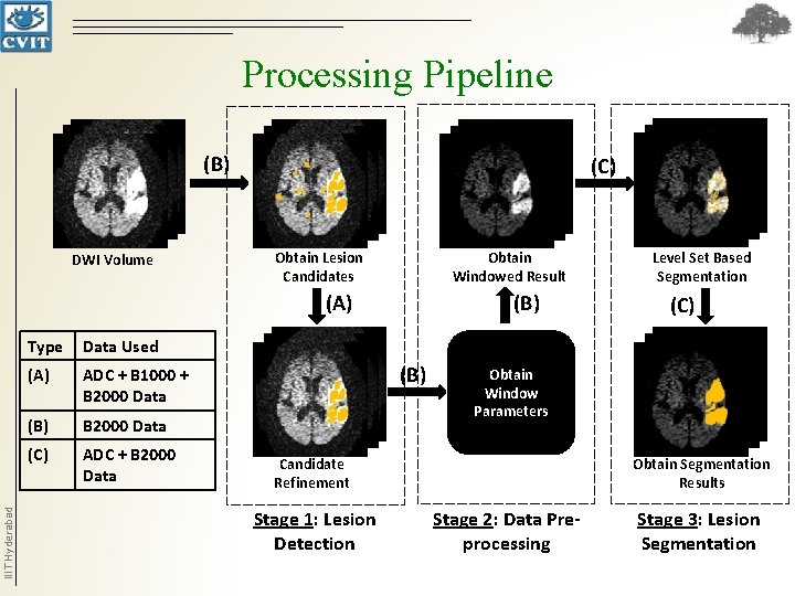 Processing Pipeline (B) DWI Volume (C) Obtain Windowed Result Obtain Lesion Candidates IIIT Hyderabad Processing Pipeline (B) DWI Volume (C) Obtain Windowed Result Obtain Lesion Candidates IIIT Hyderabad