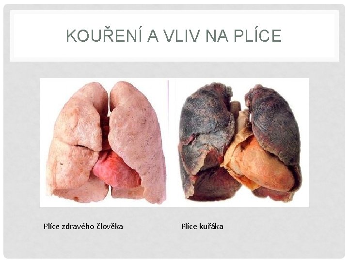 KOUŘENÍ A VLIV NA PLÍCE Plíce zdravého člověka Plíce kuřáka 