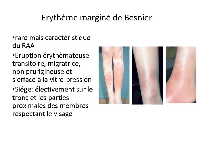 Erythème marginé de Besnier • rare mais caractéristique du RAA • Eruption érythèmateuse transitoire,