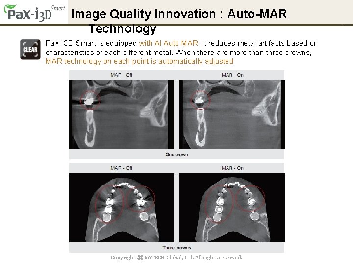 Image Quality Innovation : Auto-MAR Technology Pa. X-i 3 D Smart is equipped with