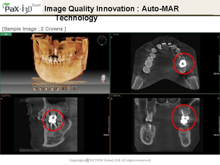 Image Quality Innovation : Auto-MAR Technology [Sample Image : 2 Crowns ] Copyrightsⓒ VATECH