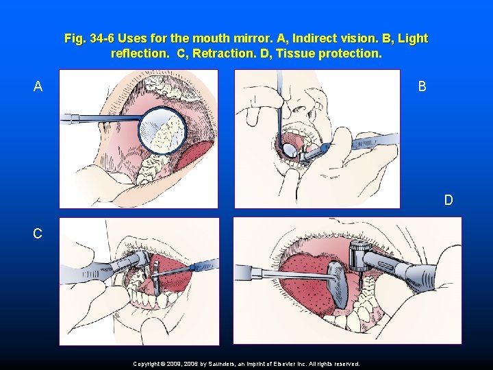 Fig. 34 -6 Uses for the mouth mirror. A, Indirect vision. B, Light reflection.