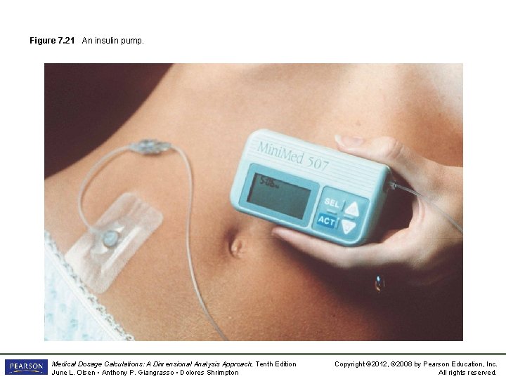 Figure 7. 21 An insulin pump. Medical Dosage Calculations: A Dimensional Analysis Approach, Tenth