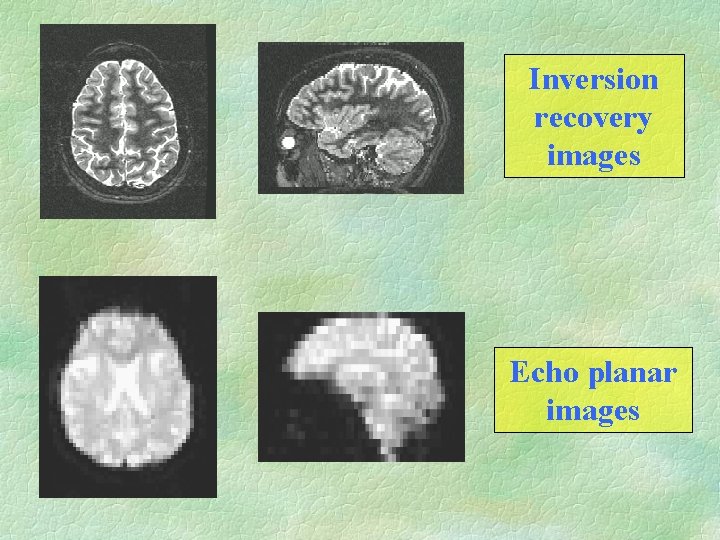Inversion recovery images Echo planar images 