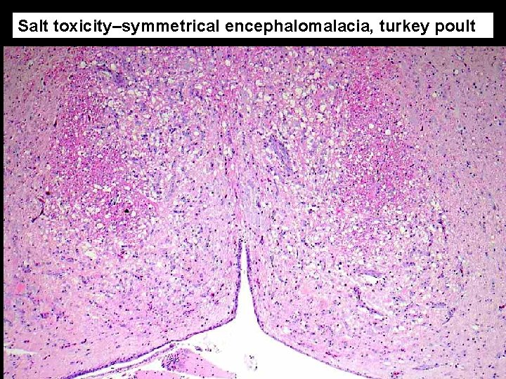 Salt toxicity–symmetrical encephalomalacia, turkey poult 