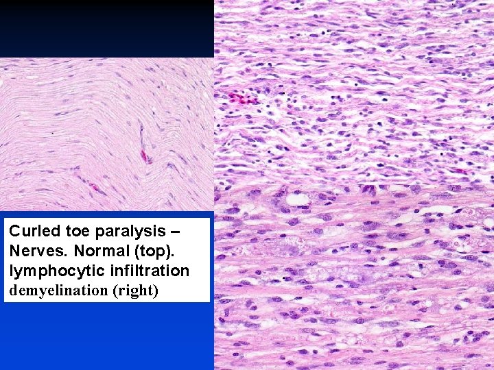Curled toe paralysis – Nerves. Normal (top). lymphocytic infiltration demyelination (right) 