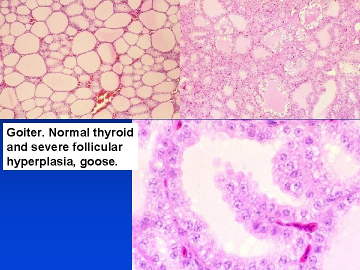 Goiter. Normal thyroid and severe follicular hyperplasia, goose. 