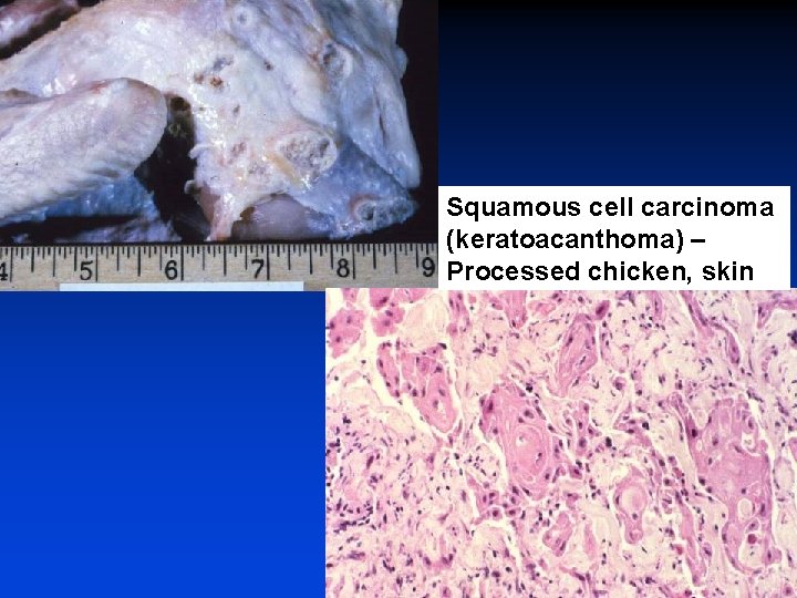 Squamous cell carcinoma (keratoacanthoma) – Processed chicken, skin 