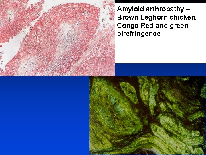Amyloid arthropathy – Brown Leghorn chicken. Congo Red and green birefringence 