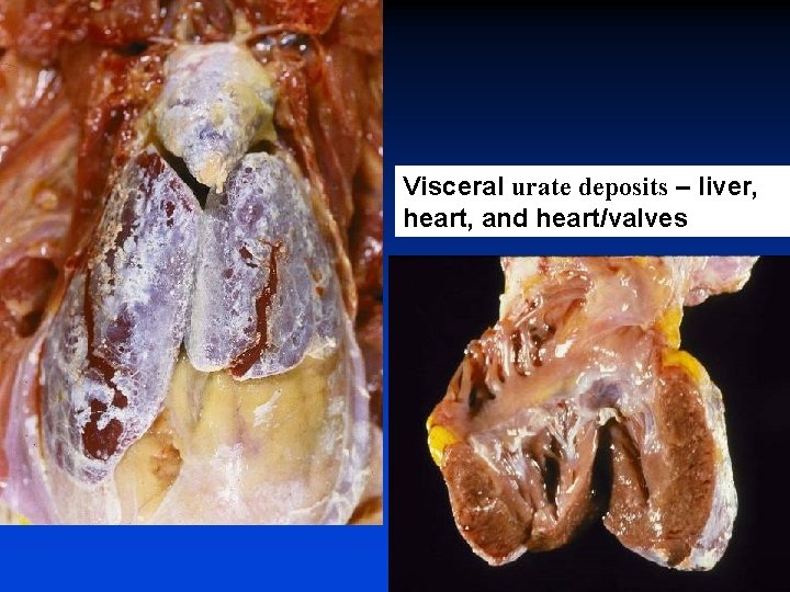 Visceral urate deposits – liver, heart, and heart/valves 