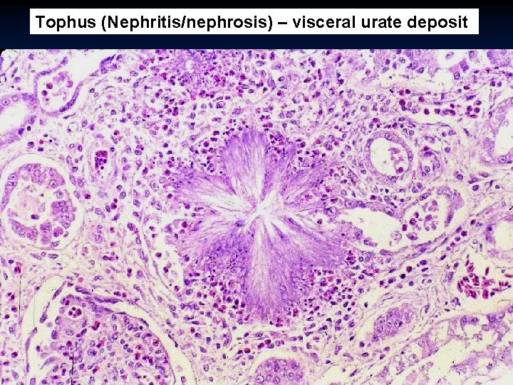 Tophus (Nephritis/nephrosis) – visceral urate deposit 