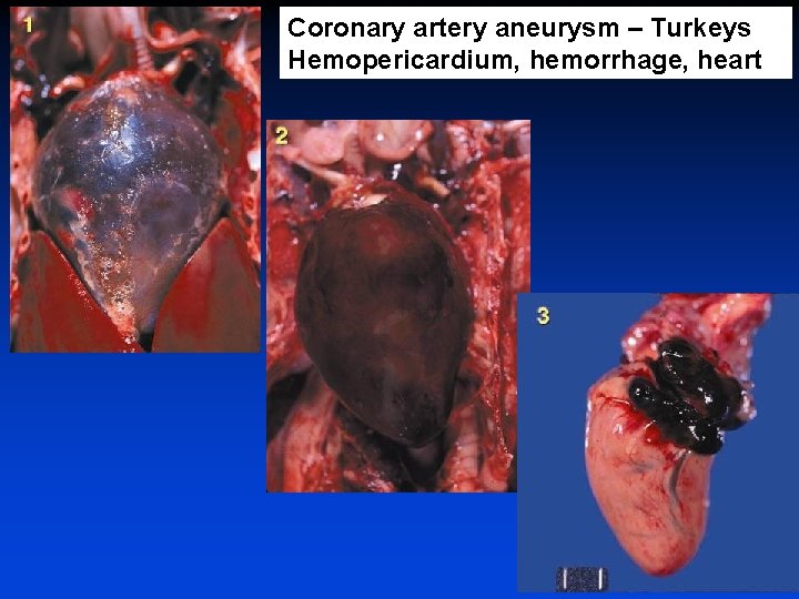 Coronary artery aneurysm – Turkeys Hemopericardium, hemorrhage, heart 