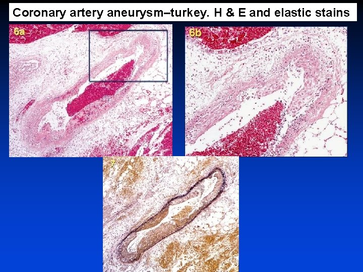 Coronary artery aneurysm–turkey. H & E and elastic stains 