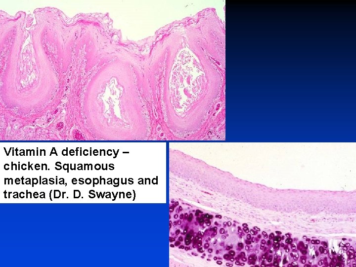 Vitamin A deficiency – chicken. Squamous metaplasia, esophagus and trachea (Dr. D. Swayne) 