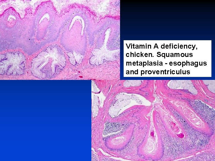 Vitamin A deficiency, chicken. Squamous metaplasia - esophagus and proventriculus 