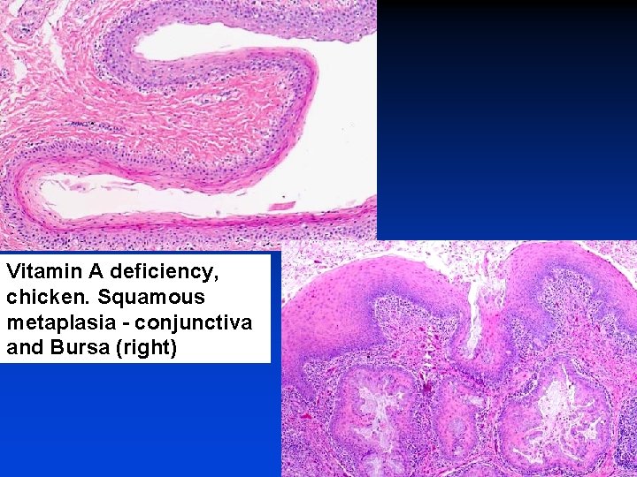 Vitamin A deficiency, chicken. Squamous metaplasia - conjunctiva and Bursa (right) 