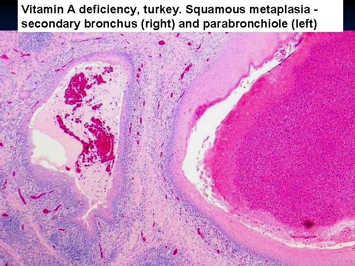 Vitamin A deficiency, turkey. Squamous metaplasia secondary bronchus (right) and parabronchiole (left) 