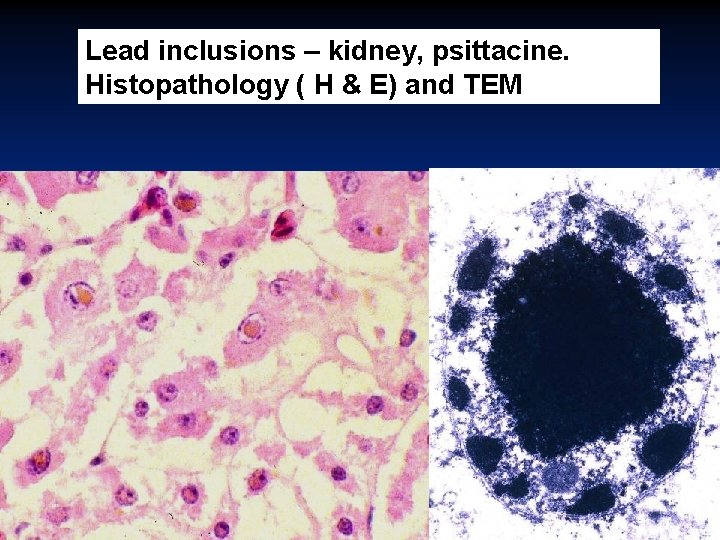 Lead inclusions – kidney, psittacine. Histopathology ( H & E) and TEM 