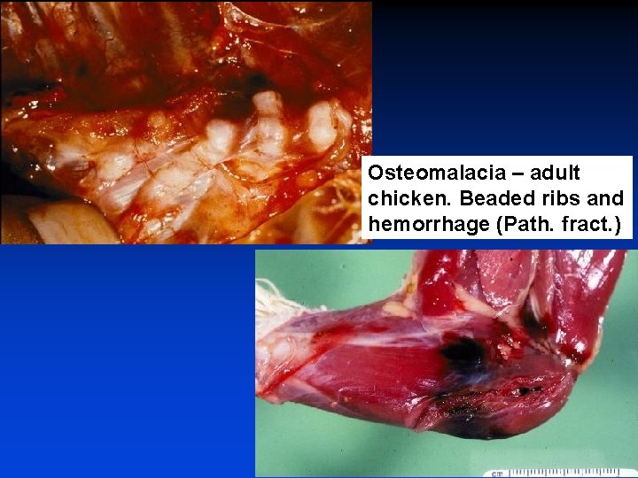 Osteomalacia – adult chicken. Beaded ribs and hemorrhage (Path. fract. ) 