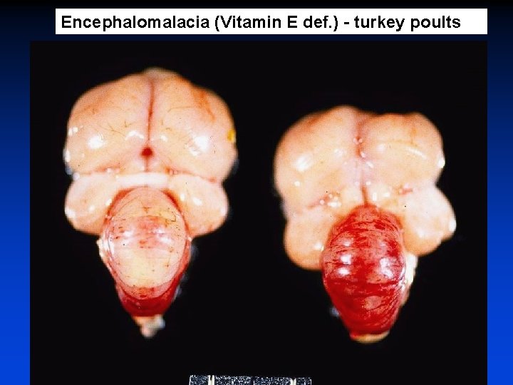 Encephalomalacia (Vitamin E def. ) - turkey poults 