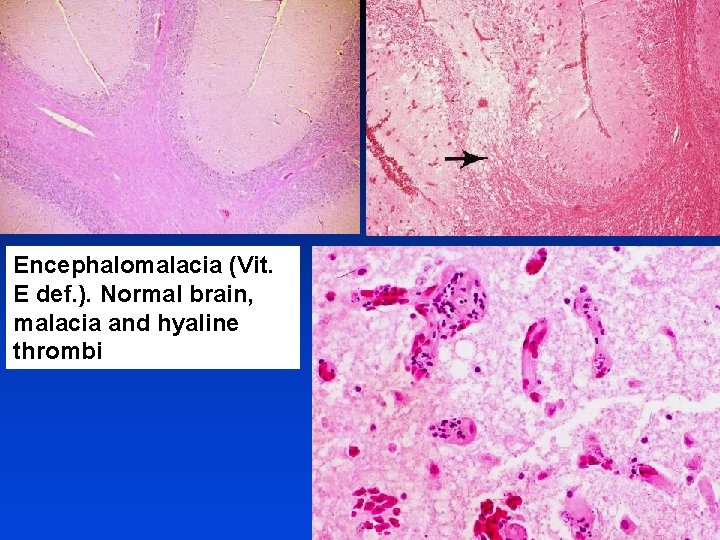 Encephalomalacia (Vit. E def. ). Normal brain, malacia and hyaline thrombi 