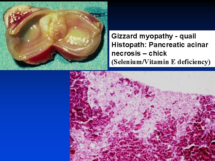 Gizzard myopathy - quail Histopath: Pancreatic acinar necrosis – chick (Selenium/Vitamin E deficiency) 