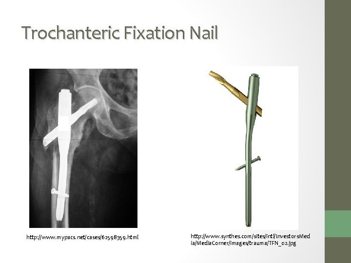 Trochanteric Fixation Nail http: //www. mypacs. net/cases/62598359. html http: //www. synthes. com/sites/intl/Investors. Med ia/Media.