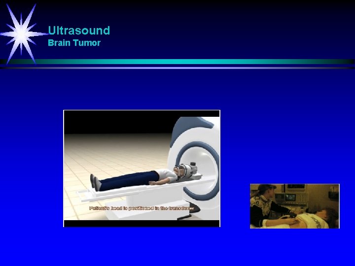 Ultrasound Brain Tumor 