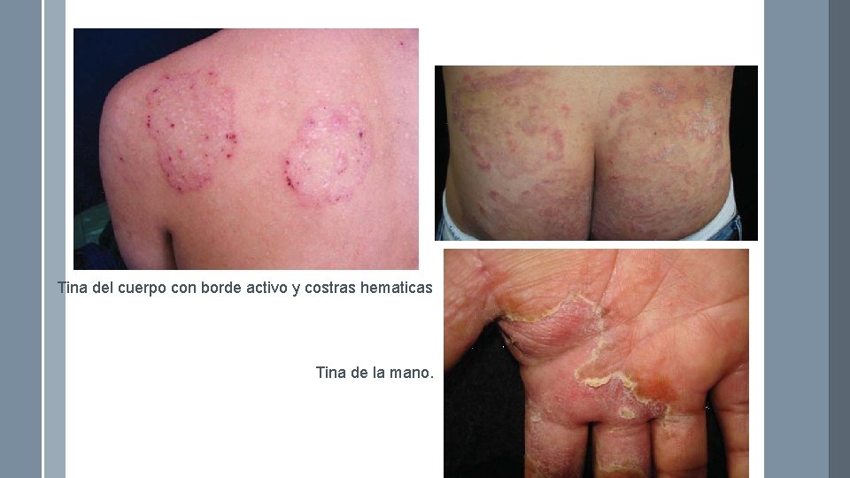 Tina del cuerpo con borde activo y costras hematicas Tina de la mano. 